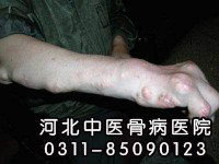 痛风的症状有哪些