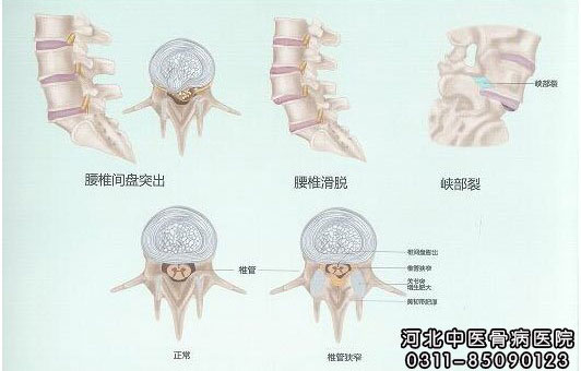 微创&椎间孔镜手术告患者书