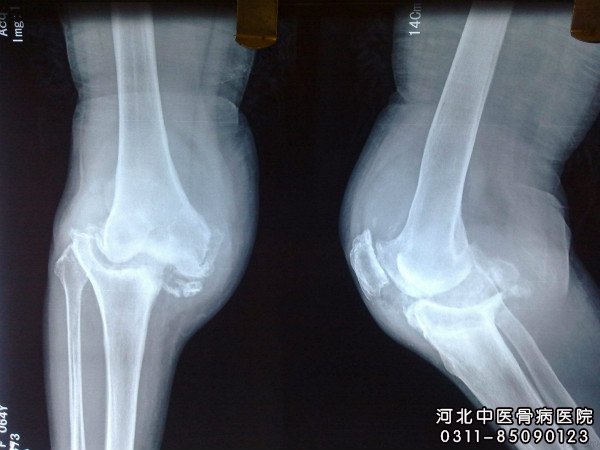 膝关节结核