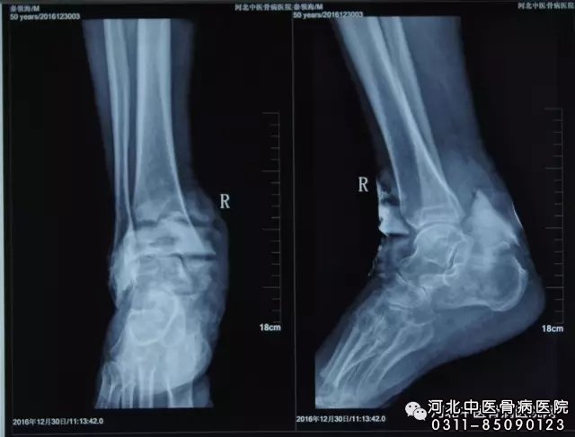 骨髓炎ct片