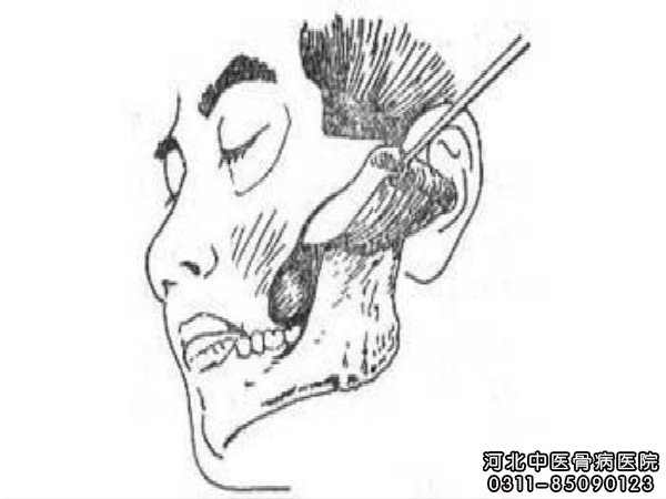 颌骨骨髓炎的症状是什么__河北中医骨病医院