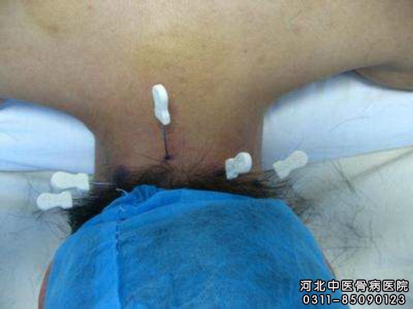 小针刀疗法