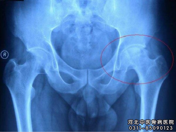 股骨头坏死X片显示坏死的部位