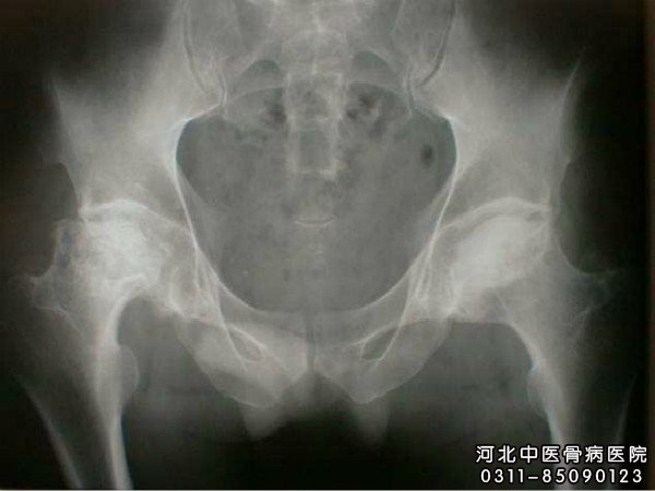 股骨头坏死的X片显示坏死的程度