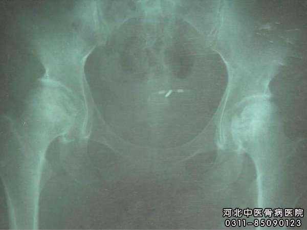 股骨头坏死X片显示已经坏死的部位