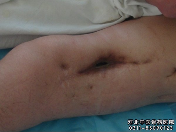 硬化性骨髓炎的主要症状有哪些__河北中医骨病医院