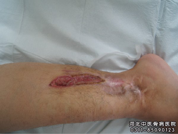 骨髓炎患者的伤口照片