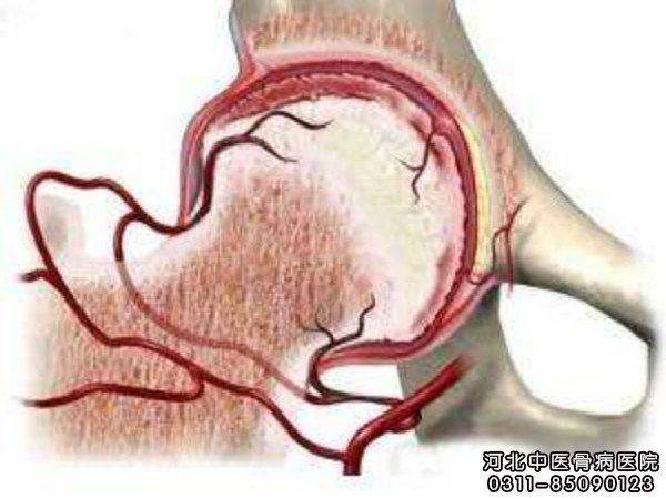 治疗股骨头坏死有哪些误区