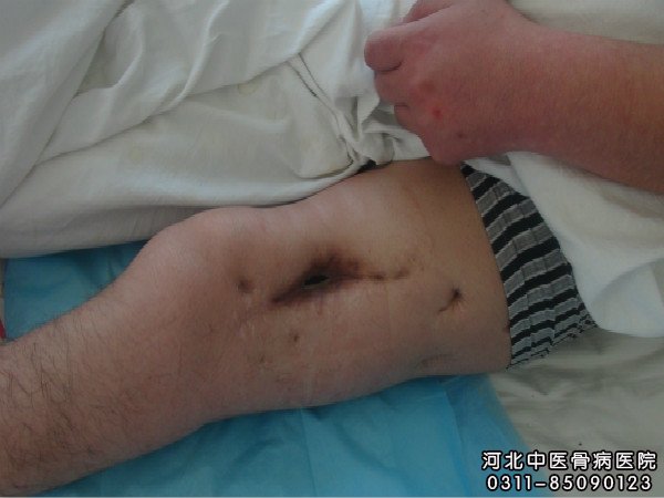骨髓炎患者治疗一段时间后的伤口处