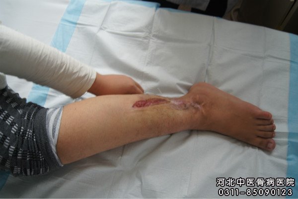 腿部骨髓炎患者的伤口
