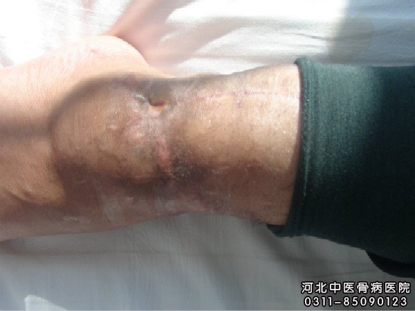 骨髓炎足部患者的伤口处