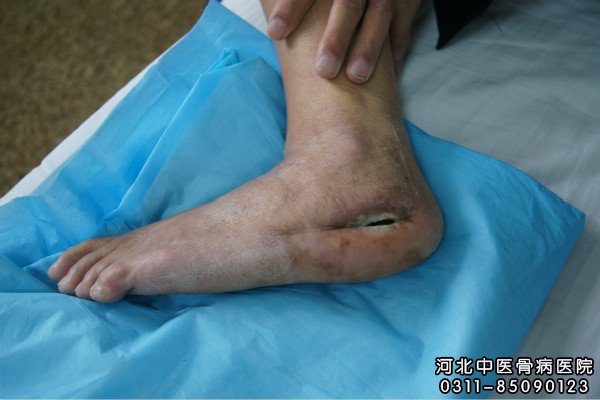 足部骨髓炎住院患者的伤口部位