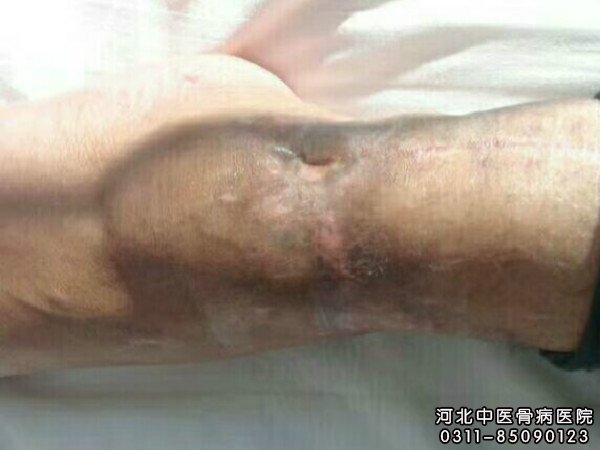 骨髓炎患者伤口恢复一周以后