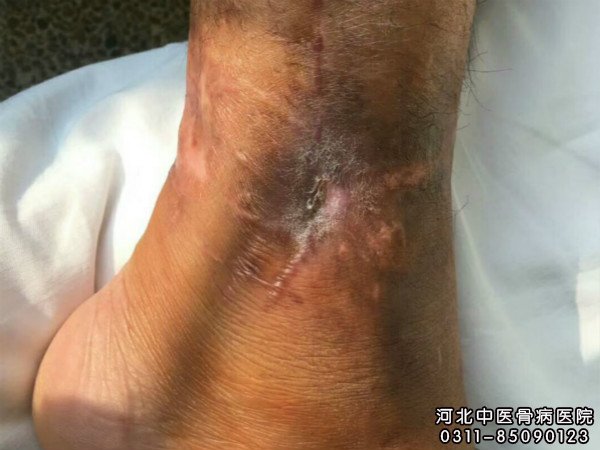 骨髓炎患者伤口已经基本长好