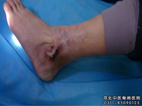 我院足部骨髓炎患者的伤口部位
