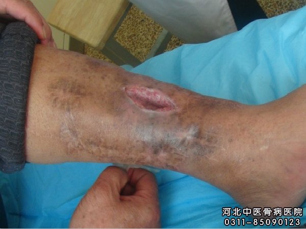 骨髓炎住院患者的伤口部位