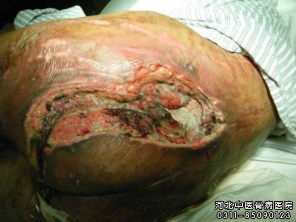 患上褥疮对于病人来说可谓给患者的整个家庭带来难处,褥疮也需要做好