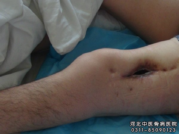 外伤性骨髓炎患者的伤口部位
