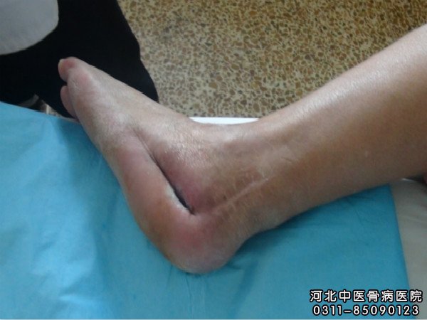 骨髓炎足部患者的伤口部位