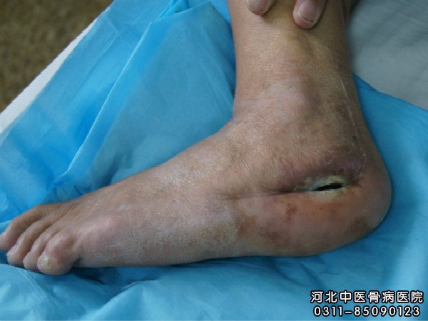 足部骨髓炎患者的伤口