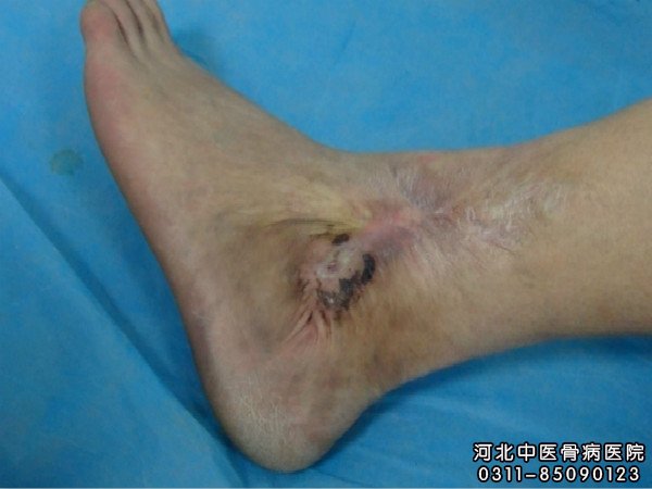 骨髓炎足部患者的伤口