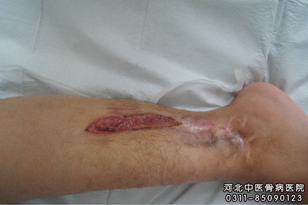骨髓炎患者的伤口部位
