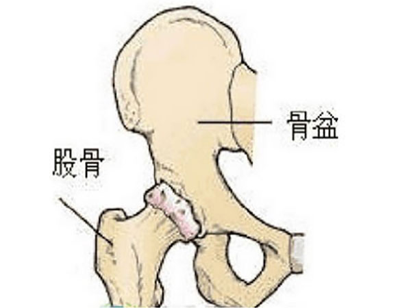 为什么肥胖者更易导致股骨头坏死