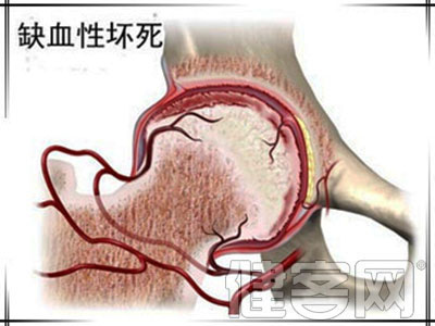 中医解答股骨头坏死的原因