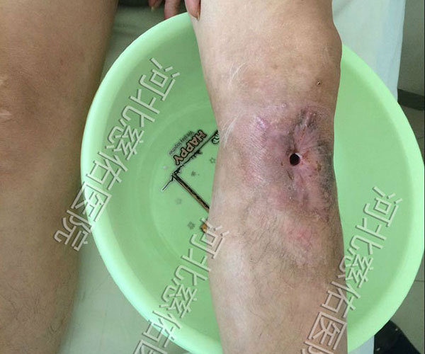 骨髓炎怎么治疗