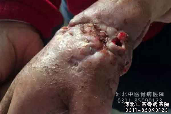 右手骨髓炎案例