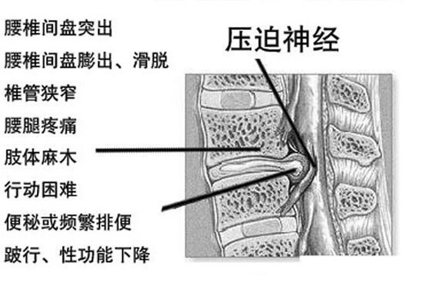 腰椎间盘突出的病因有哪些