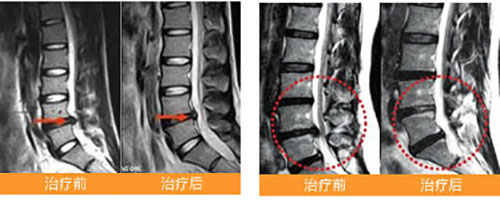 椎管狭窄怎么治效果好