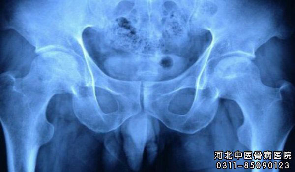 儿童股骨头坏死