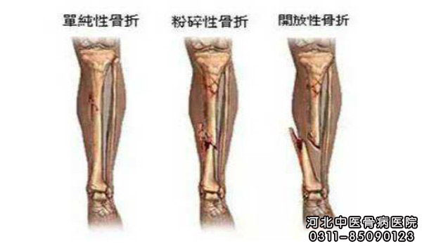 骨折