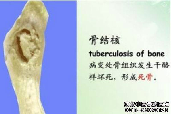 骨结核