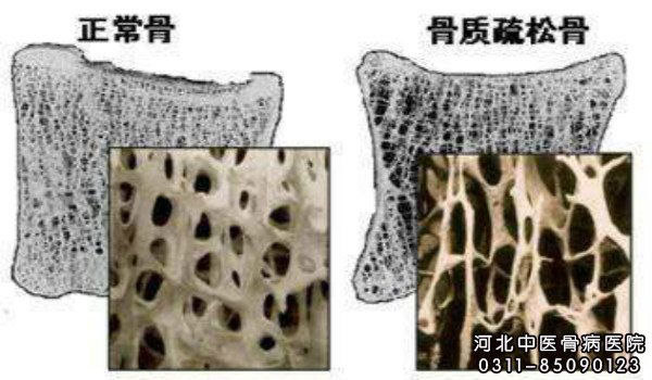 骨质疏松