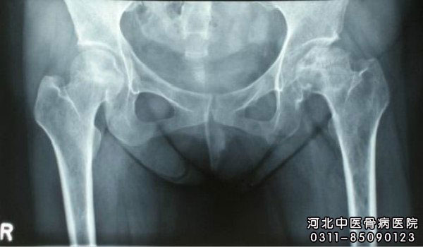 股骨头坏死