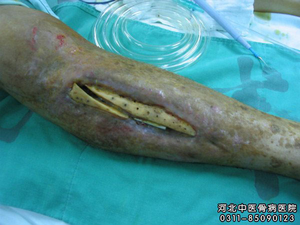 骨髓炎