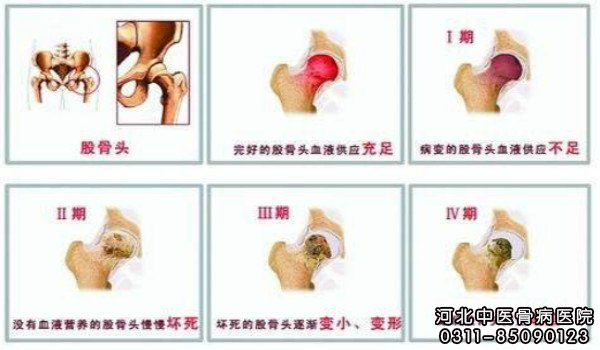 股骨头坏死