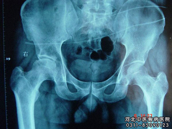 股骨头坏死