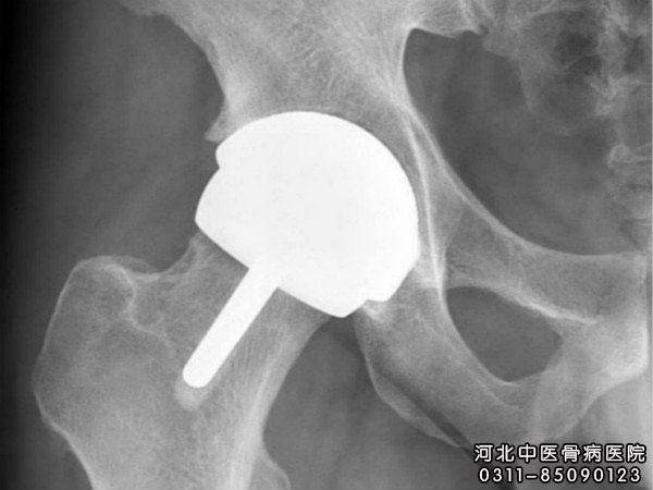 股骨头坏死