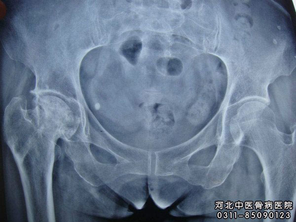 股骨头坏死