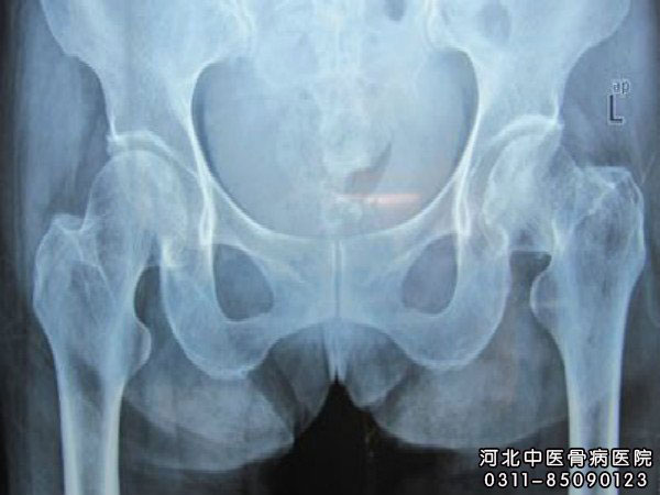 股骨头坏死