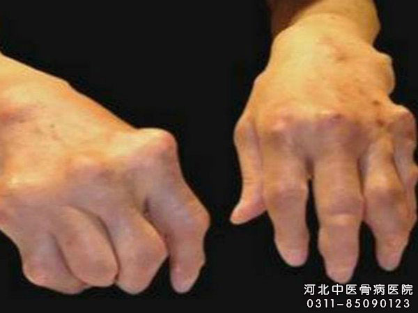 风湿