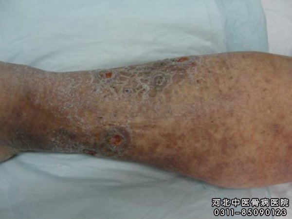 小腿慢性溃疡
