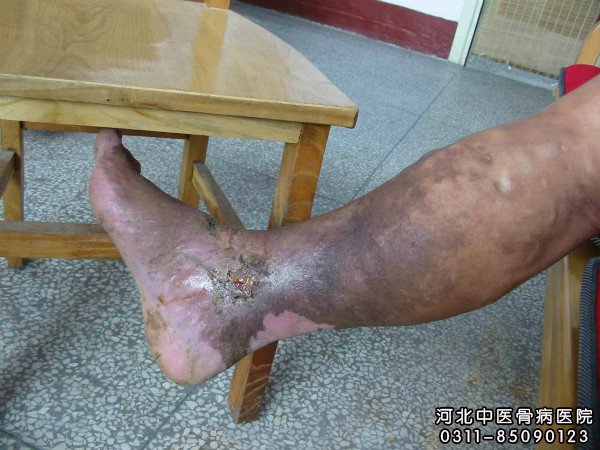 小腿慢性溃疡