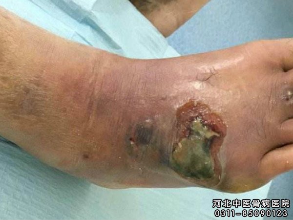 右足骨髓炎