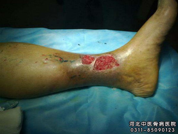 小腿慢性溃疡