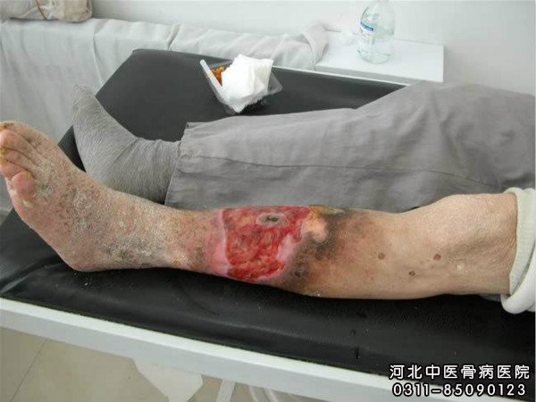 小腿慢性溃疡