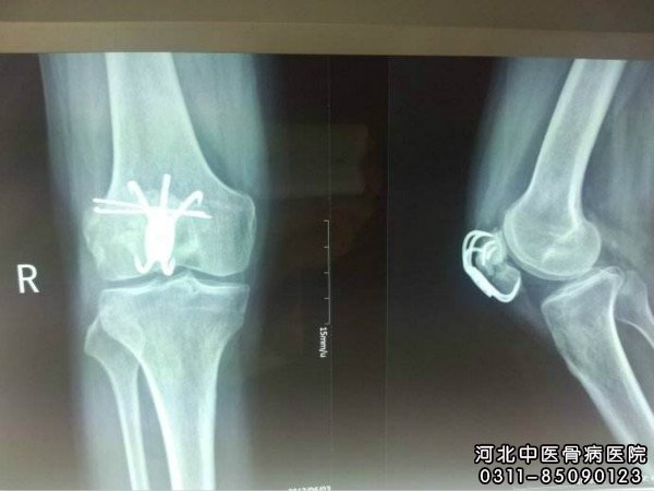 骨不连